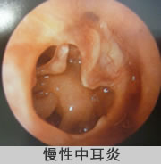 慢性中耳炎