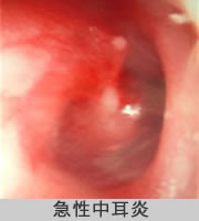 急性中耳炎の写真