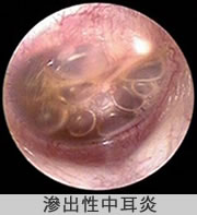 滲出性中耳炎の写真