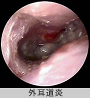 外耳道炎