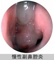 慢性副鼻腔炎の写真