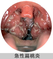 急性扁桃炎の写真